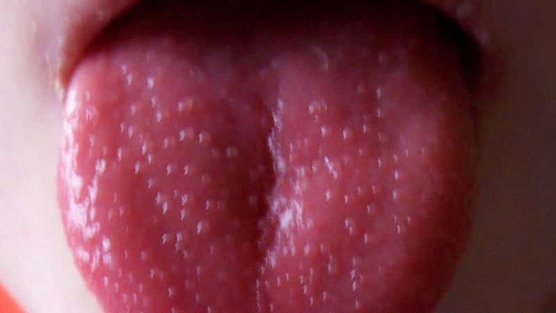 на корне язика волдыри фото