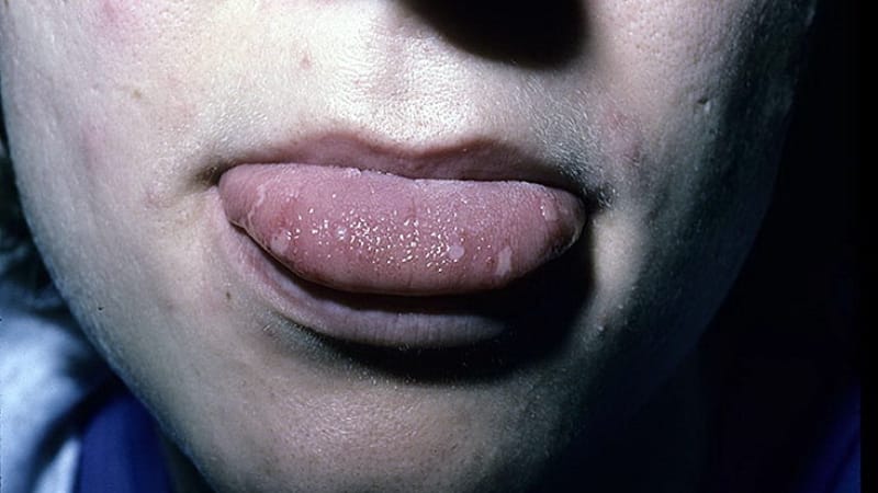 волдыри на корне язика причины