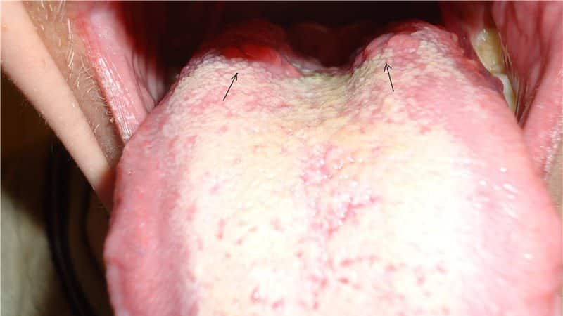 Волдыри на языке у ребенка: фото