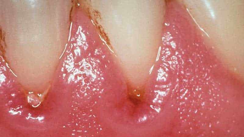 Чем лечить десна если они воспалились