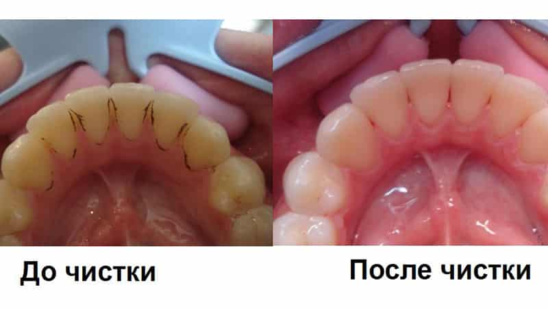Чем лечить воспаление десен