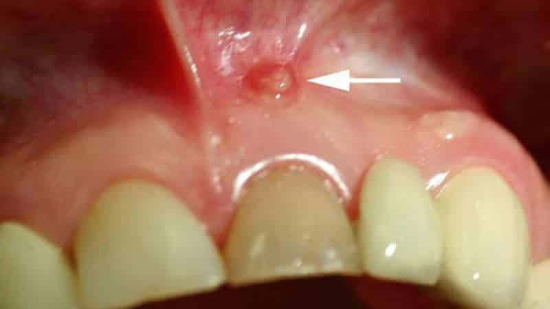 Лечение воспаленных десен