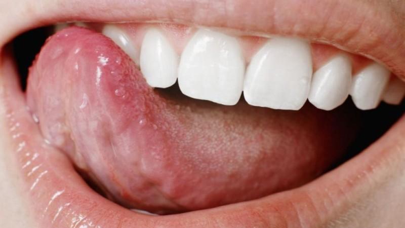 воспаление корня языка фото