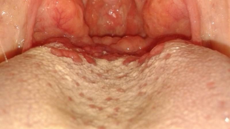 воспаление на языке сбоку лечение