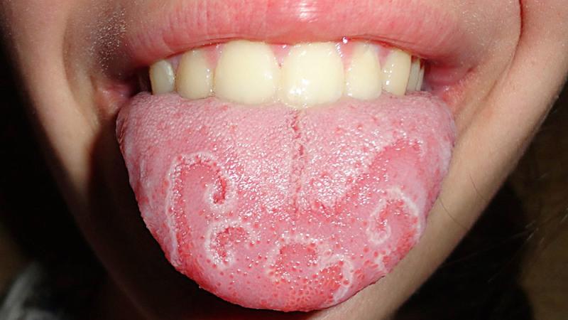 воспаление кончика языка лечение