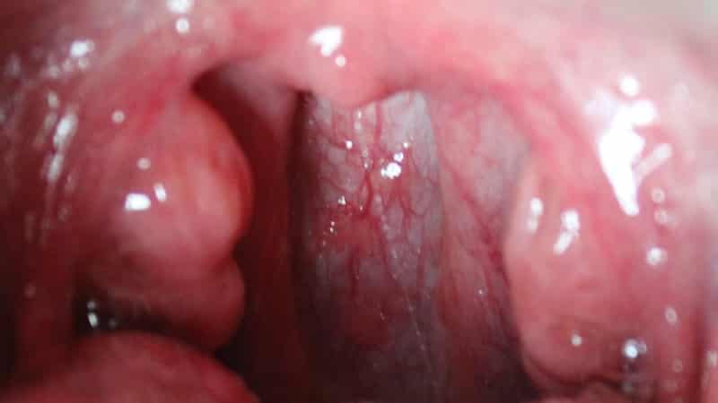 воспаление миндалин у ребенка