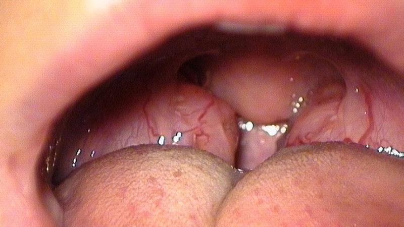 воспаленные миндалины фото