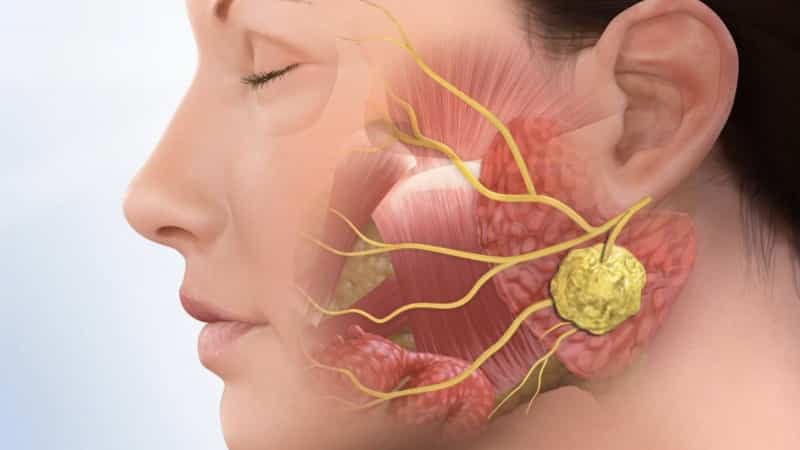 распухло под языком воспалилась железа фото