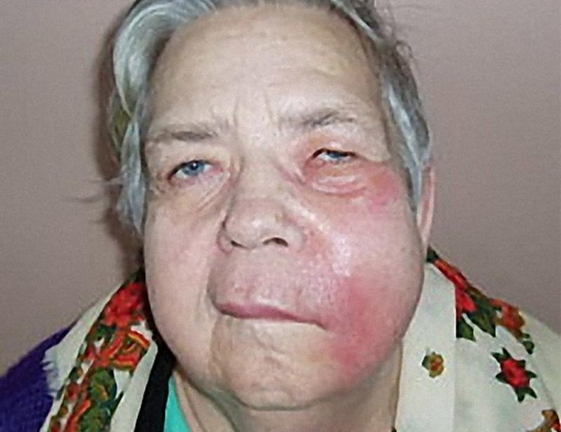 воспаление щеки изнутри