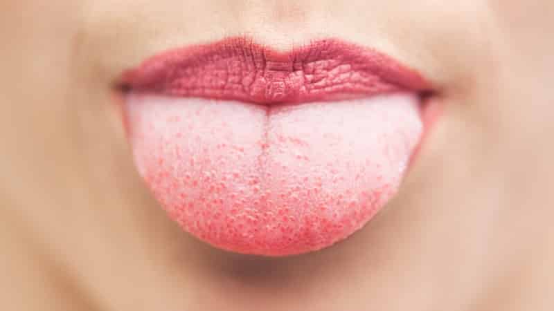 воспаление сосочков на языке фото