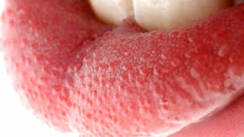 воспаление сосочков языка