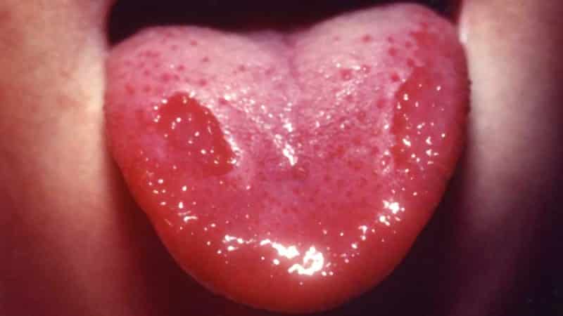 на языке увеличены сосочки