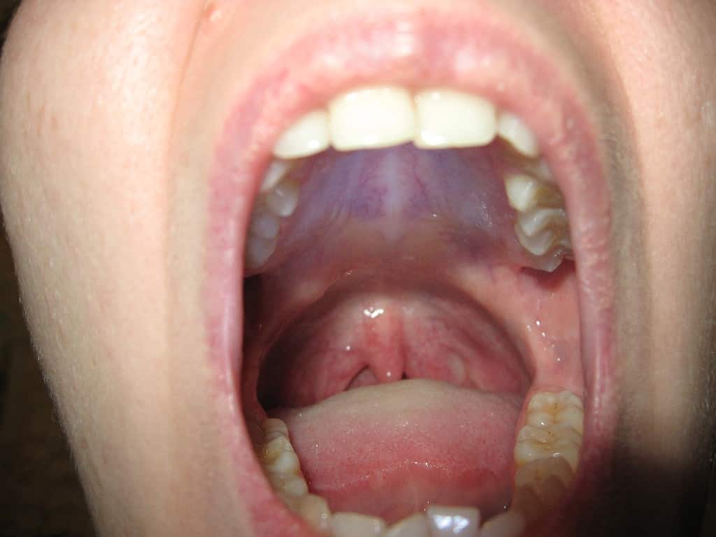 болит воспаление неба внутри сверху как лечить на небе во рту причины лечение в домашних условиях фото