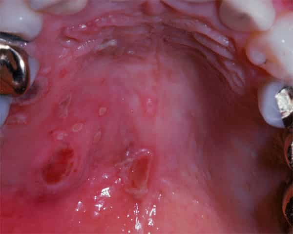 чешется воспалилось верхнее небо во рту чем лечить причины что делать