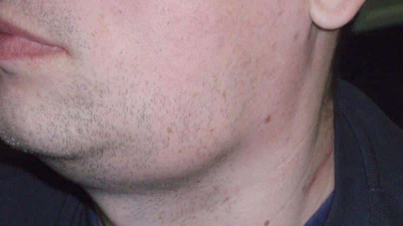 воспалены болят подчелюстные лимфоузлы увеличены причины фото