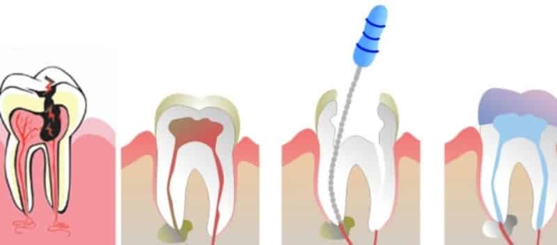 Воспаление зубного нерва симптомы и лечение