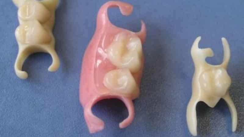 Виды временных протезов