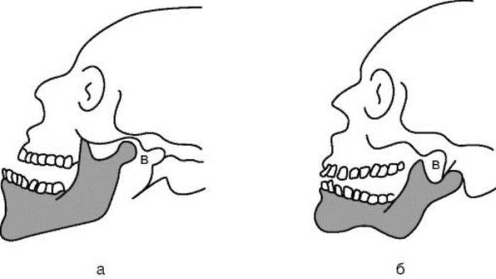 вывих нижней челюсти симптомы