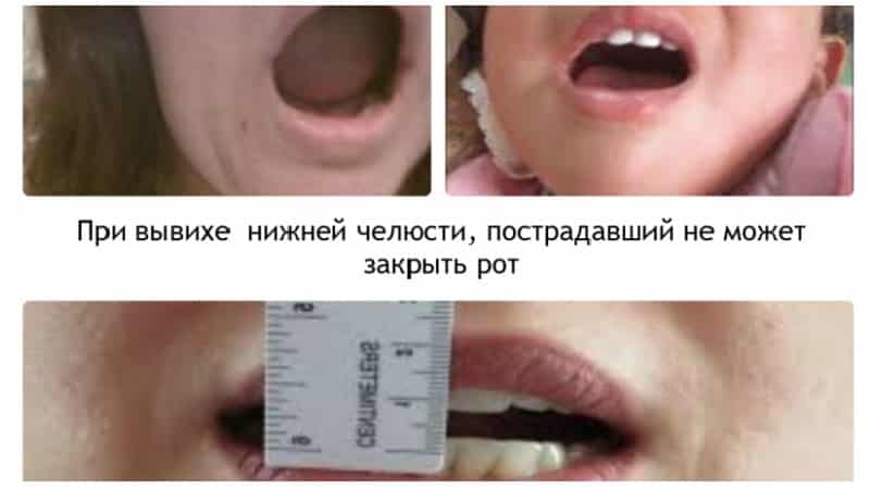 вывих челюсти фото