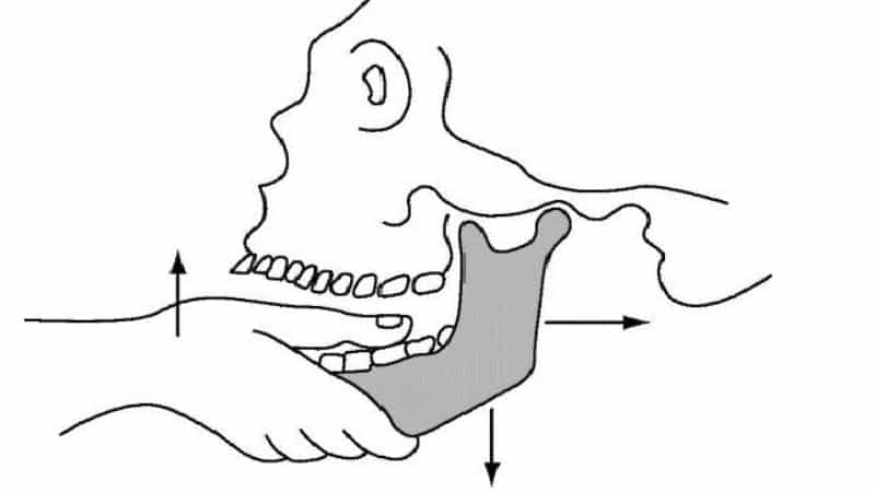 смещение нижней челюсти