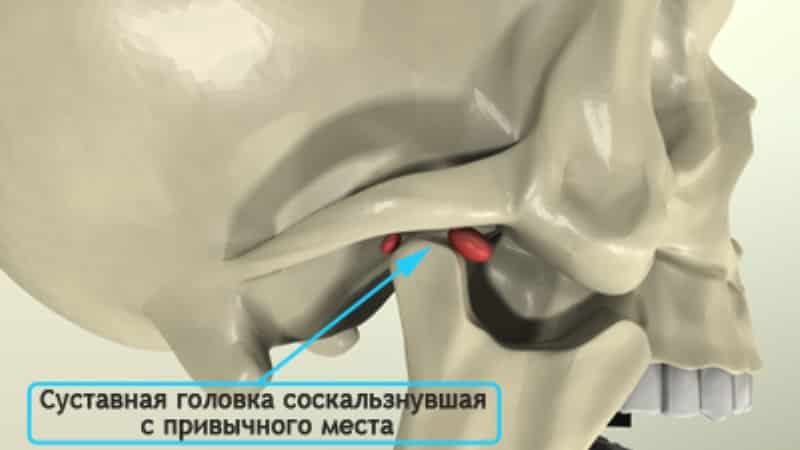 как вставить челюсть на место самому