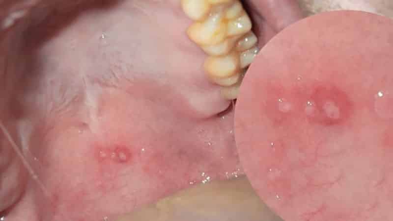 Язвочки на небе