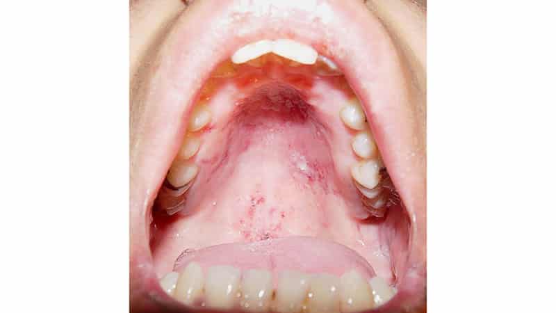 Язвочки на небе