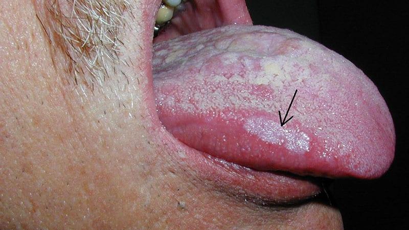 Язвы на языке - как лечить