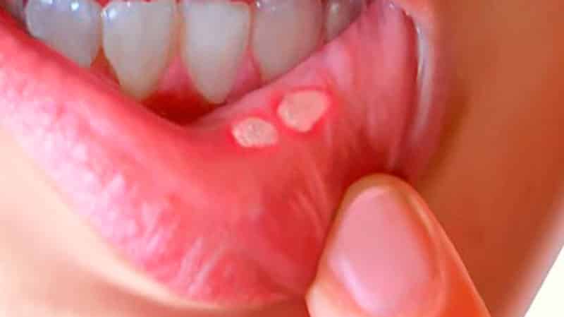 Язвы во рту