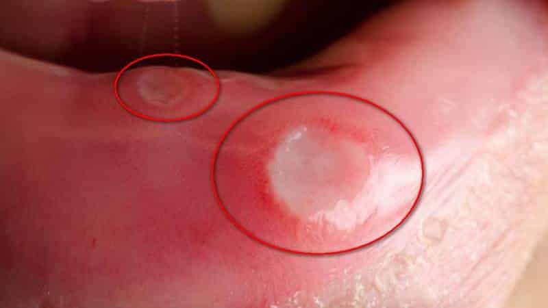 болезни полости рта у взрослых фото