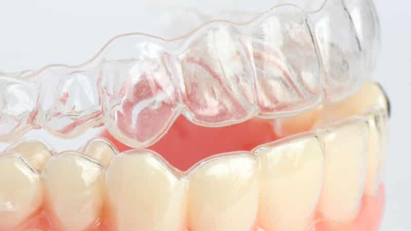 капы для выравнивания зубов исправления прикуса у детей фото сколько стоят,