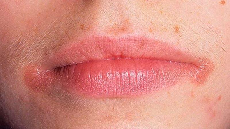 Заеды на губах
