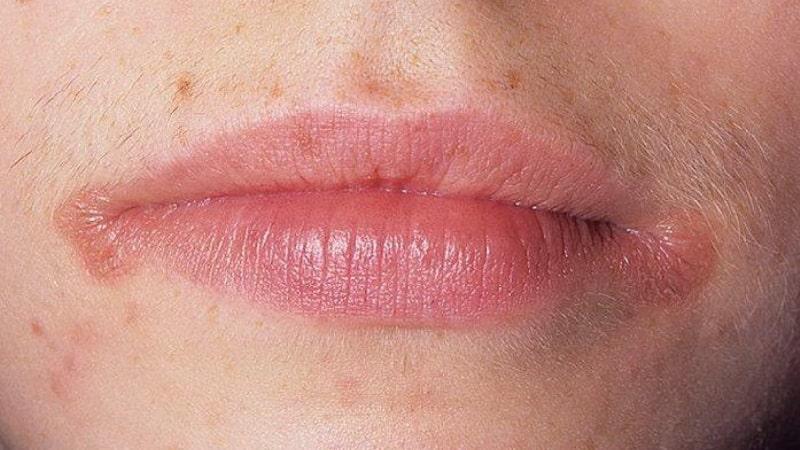 заеды в уголках рта у беременных причины и лечение