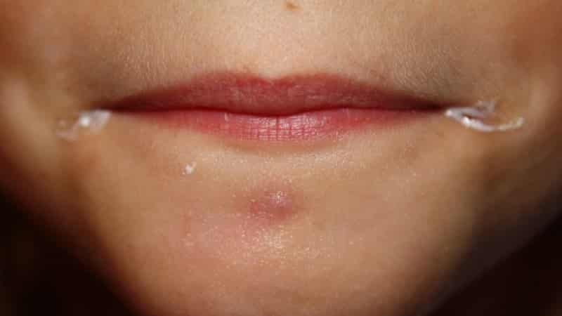 заеды у беременных