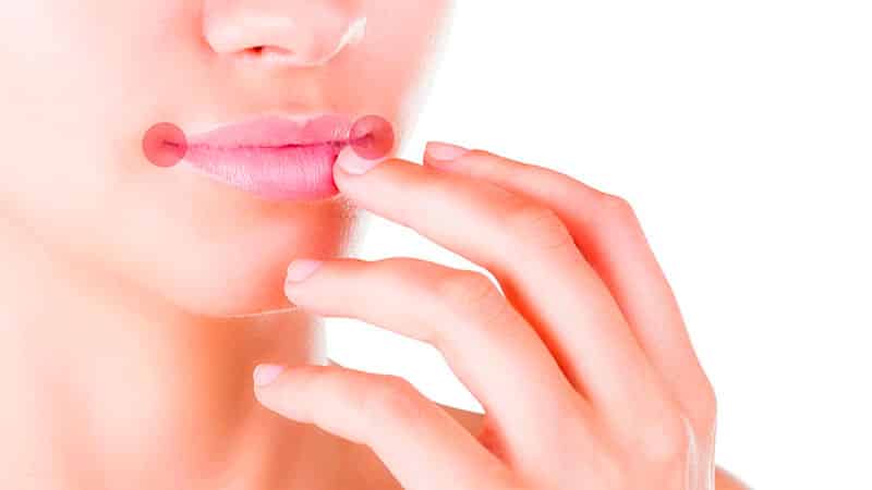 чем лечить заеды