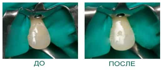 Защита околозубных тканей Защита околозубных тканей