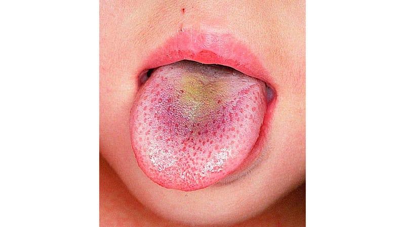 Зеленый налет на языке