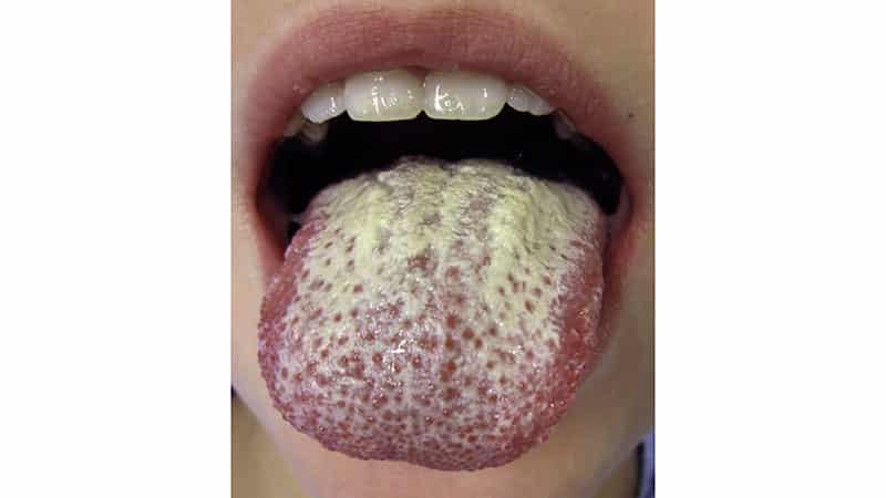 Желтый язык