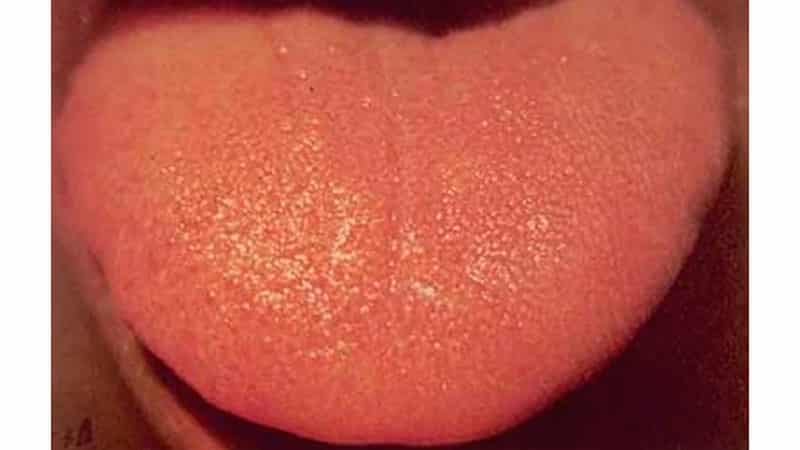 Желтый язык - причина