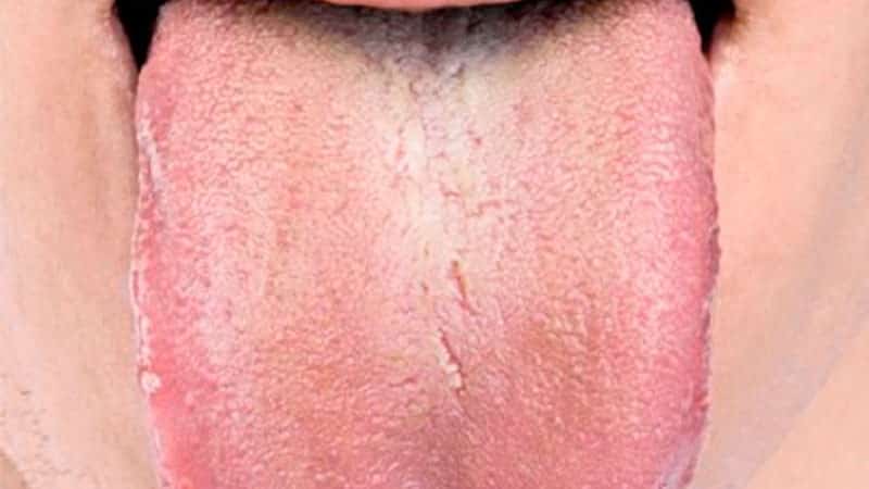 Желтый язык - причина