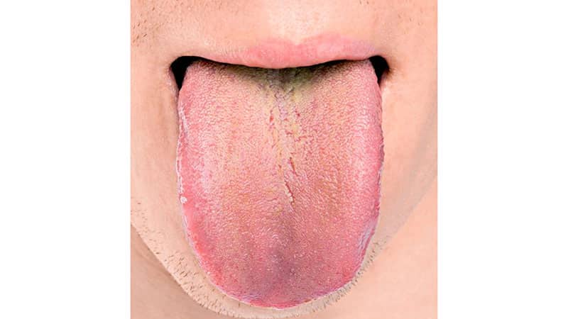 Желтый язык - причина