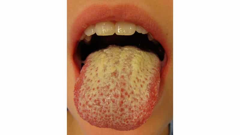 Желтый язык - причина