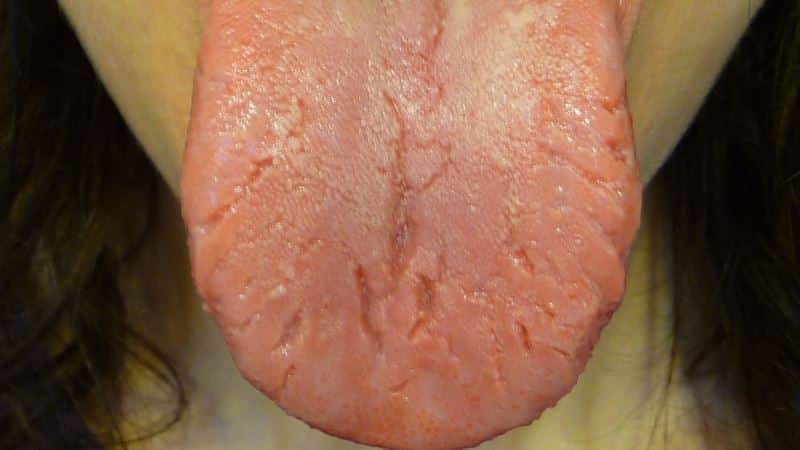 печет небо во рту причины