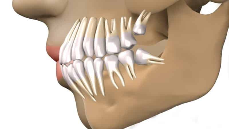зуб мудрости растет в щеку фото