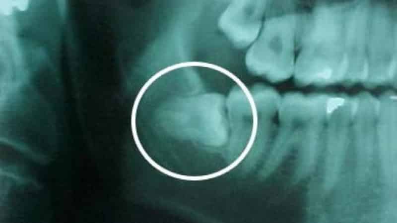 зуб мудрости растет в бок