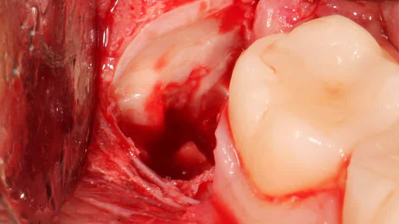 Последствия удаления 8 зуба