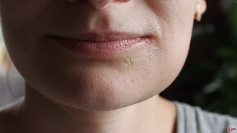 Не открывается челюсть после удаления зуба мудрости