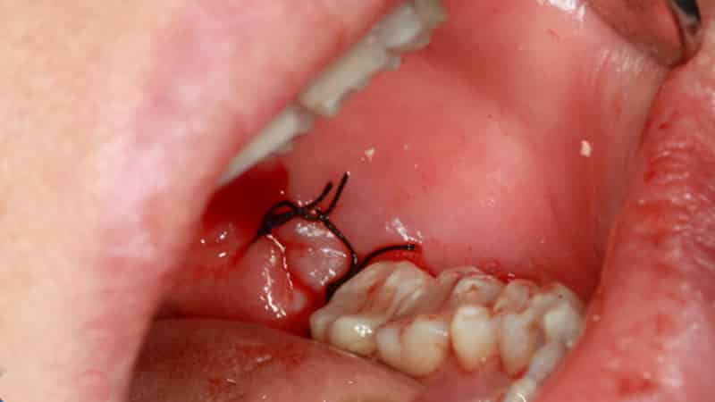 Последствия удаления зуба мудрости