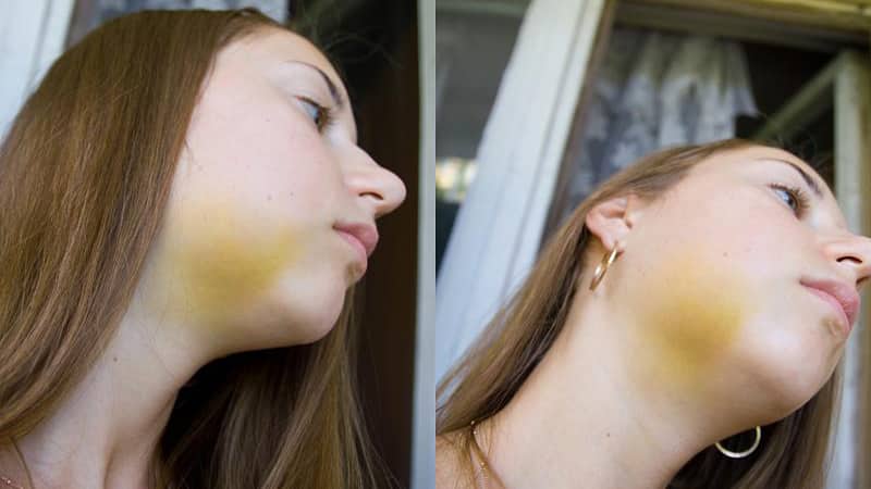 Гематома после удаления зуба мудрости