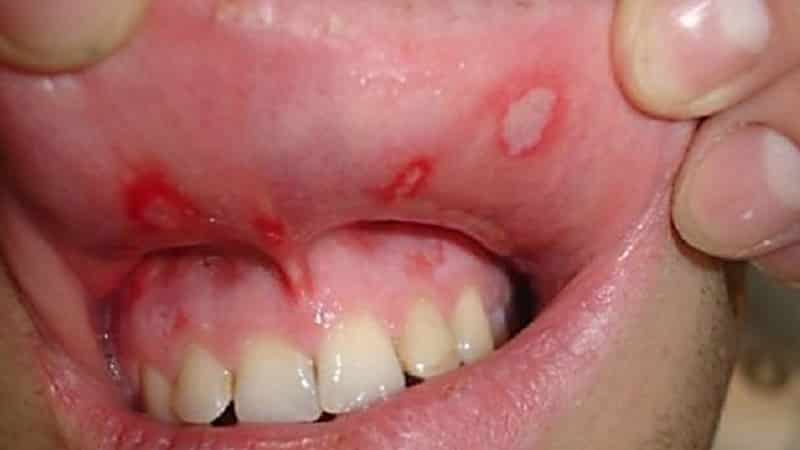 болят зубы от сладкого что делать